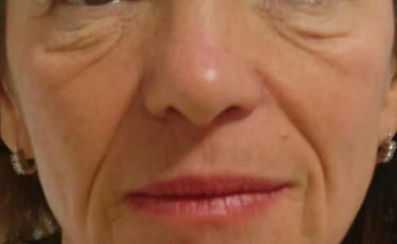 trattemento ginnastica facciale con metodo visofit